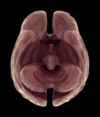 Brain Atrophy Or Severe Shrinkage Of The Brain Caused By Dementia And Alzheimer Royalty Free Stock Photo