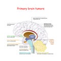 Brain cancer. different types of primary brain tumors Royalty Free Stock Photo