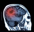 Brain cancer x-ray image Royalty Free Stock Photo