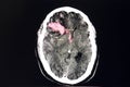 Brain CT scan, intracerebral hemorrhage