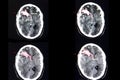 Brain CT scan, intracerebral hemorrhage Royalty Free Stock Photo