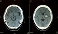 Brain CT scan showing bleeding stroke