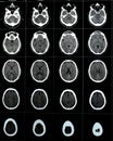 Brain CT scan showing brainstem cavernoma, right centrum semiovale developmental venous anomaly, intra cerebral haematoma, faint