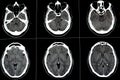 Brain CT scan showing brainstem cavernoma, right centrum semiovale developmental venous anomaly, intra cerebral haematoma, faint