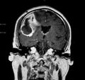 Brain CT showing E. coli Brain Abscess