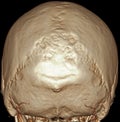 Brain 3D CT
