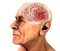 Brain, Degenerative Diseases, Alzheimer`s, Parkinson`s. Old man Royalty Free Stock Photo