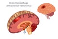 Brain Hemorrhage Intracranial hematoma Royalty Free Stock Photo