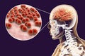 Brain infection caused by Streptococcus pneumoniae bacteria Royalty Free Stock Photo