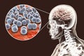 Brain infection caused by Streptococcus pneumoniae bacteria Royalty Free Stock Photo