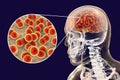 Brain infection with Neisseria meningitidis bacteria Royalty Free Stock Photo