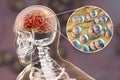 Brain infection with Neisseria meningitidis bacteria Royalty Free Stock Photo