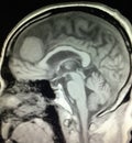 Brain meningioma headache mri examination