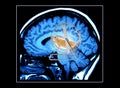 Brain MRI Scan Mouse Wheel Royalty Free Stock Photo