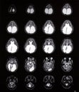 Brain mri showing enlarged ventricles