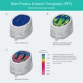 Brain PET scans. Royalty Free Stock Photo