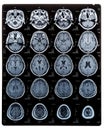 Brain scan image on Magnetic Resonance Imaging (MRI) film of elderly patient isolated (clipping path)