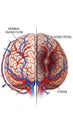 Brain showing normal blood circulation contrasted with cortical vessel blockage causing ischemic stroke, cerebral Royalty Free Stock Photo