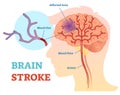 Brain Stroke anatomical vector illustration diagram, scheme
