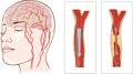 Brain stroke. Cerebral infarction