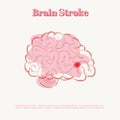 Brain stroke disease. Heart awareness concept. Atherosclerosis stages. Royalty Free Stock Photo