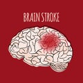 BRAIN STROKE Insult Medicine Health Vector Illustration