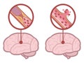 Brain stroke - ischemic and hemorrhagic