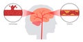 Brain stroke ishemic and hemorrhagic