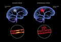 Brain stroke ishemic and hemorrhagic