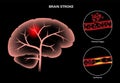 Brain stroke ishemic and hemorrhagic Royalty Free Stock Photo