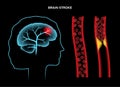 Brain stroke ishemic Royalty Free Stock Photo