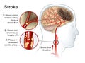 Brain stroke, medically accurate illustration