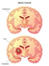 Brain tumor