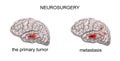 Brain tumor, neurosurgery