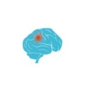 Brain tumor vector design