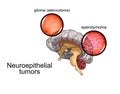 Brain tumour 2, neurosurgery