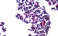 Branching budding yeast cells with pseudohyphae in urine gram st