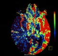 Brain ischaemic stroke. CT-scan reconstruction, perfusion..