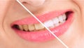 Breaching teatment, woman perfect whiten teeth Royalty Free Stock Photo