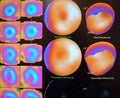 nuclear stress test woman breast attenuation