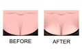 The breast augmentation. plastic surgery Royalty Free Stock Photo
