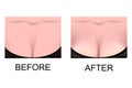 The breast augmentation. plastic surgery