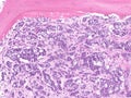 Breast cancer. Bone marrow metastases. Royalty Free Stock Photo