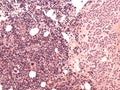 Breast cancer. Bone marrow metastases. Royalty Free Stock Photo