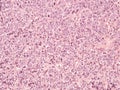 Breast cancer. Bone marrow metastases. Royalty Free Stock Photo