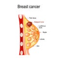 Breast cancer. Cross-section of the mammary gland with tumor