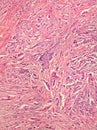 Breast Cancer Histology Royalty Free Stock Photo