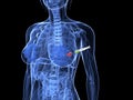 Breast cancer injection - biopsy