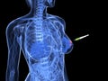 Breast cancer injection - biopsy