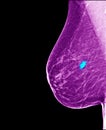 Breast cancer - mammogram Royalty Free Stock Photo